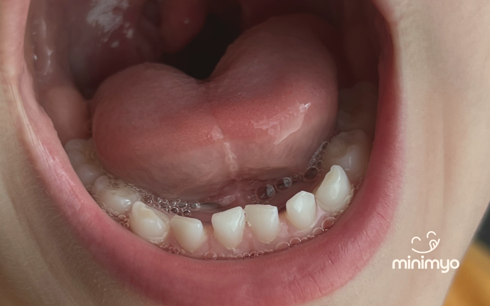 Det optimale vindue for klip af tungebånd